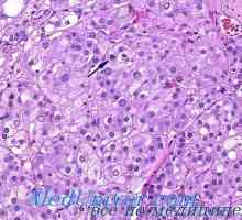 Gormonalnoaktivnye кора тумор на надбъбречната