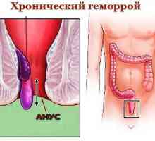 Хронични (постоянна), вътрешните и външните хемороиди