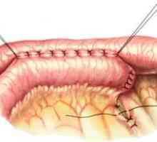 Промяна на анатомията на стомашно-чревния тракт в резултат на операция. анастомози