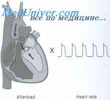 Увеличението на сърдечния дебит. хипертрофия на миокарда
