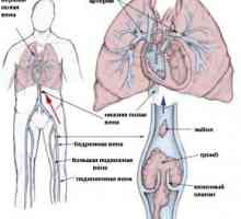 Емболия и тромбоза на артериите, лечението