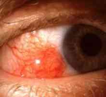Еписклерит очите: лечение, симптоми, причини