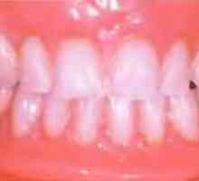 Стъпките на производството на зъбни протези долната челюст. Етапи 2 януари