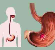 Етиологията и патогенезата на язва на стомаха