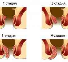 Как мъжки хемороиди на ранен етап?