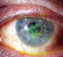 Кератитът очите: лечение, симптоми, причини, симптоми