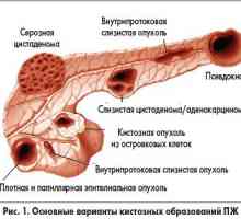 Киста на панкреаса (глава и опашка), симптомите, прогнозите за лечение на тумори, снимки