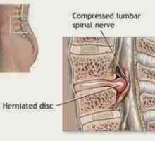 Компресия на гръбначния мозък (синдром): Симптомите, Лечение