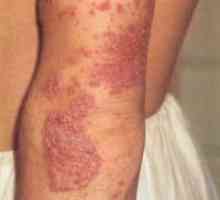 Miniatlas: кожни заболявания придружени от сърбеж