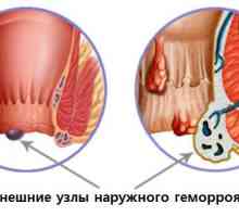 Външни хемороиди, външни хемороиди