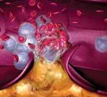 Наследствени заболявания на тромбоцитите интериор