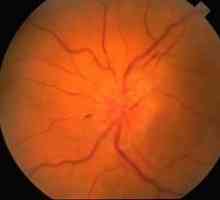 Неврит на зрителния нерв: симптоми, лечение, причини, диагностика, прогноза