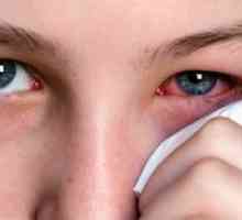 Ophthalmoherpes: лечение, симптоми