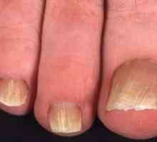 Onychomycosis Nails: лечение, симптоми, диагностика, причинява, профилактика и симптоми