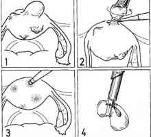 Хирургия на матката. лапароскопска миомектомия