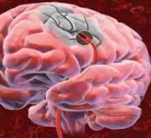 Мозъчен тумор и неговите мембрани, което води до загубата на зрителната пътека