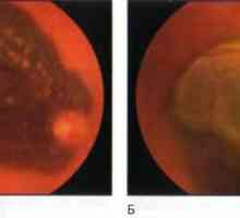 Тумори на ретината и хориоидеята: хороидална меланом