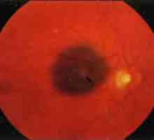 Тумори на ретината и хориоидеята: хороидални невус