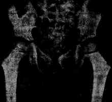 Остеолиза на ерозия на костта