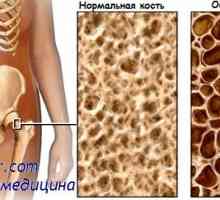 Остеомалация. Остеопорозата и характеризиране на остеопороза