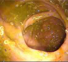 Pinworms в червата, ануса, ануса чревния ентеробиоза на