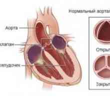 Остра дисфункция на сърдечните клапи