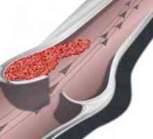 Остра тромбоза на долните крайници артерии
