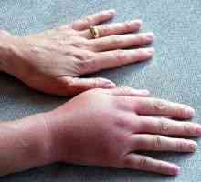 Подуване на ръката: причините, поради подуване, лечение