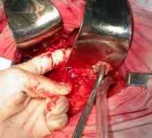 Pancreatonecrosis операция период след операция