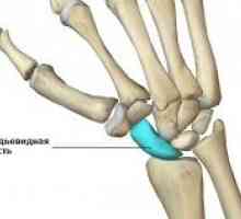 Счупване на навикуларната кост кост четка: Лечение