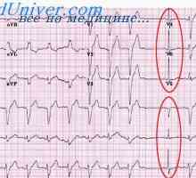 Ангина и инфаркт на ЕКГ. Промени в Т-вълната от електрокардиограмата