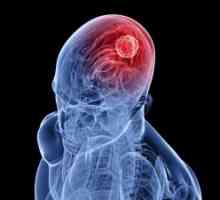 Основни мозъчни тумори: симптоми, лечение, причините, симптоми