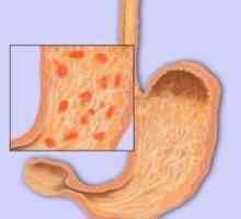 Първите признаци и симптоми на гастрит стомах