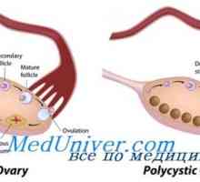 Поликистозни яйчници. синдром мат - Левентал