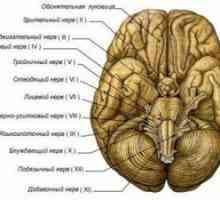 Поражението III, IV, VI черепни нерви