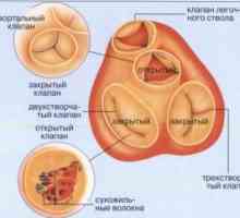Недостатъци белодробна клапан (стеноза, недостатъчност), лечение, причинява, Симптоми, признаци