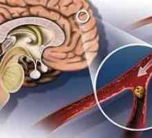 Последиците от исхемичен инсулт мозъка