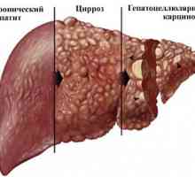 Opisthorchiasis последици при възрастни, въздействието върху човешкото тяло