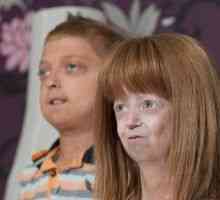 Progeria деца: симптоми, лечение, причини
