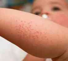 Острици прояви на обрив на кожата, когато enterobioze