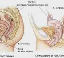 Пролапс на матката и вагината: лечение, симптоми, хирургия