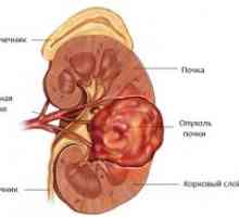 Карцином на бъбречното легенче и уретера: признаци, симптоми, причини, лечение