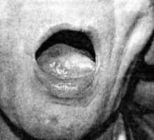 Лигавицата рак на устната лигавица