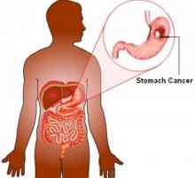 Рак на стомаха: патогенеза, хистология, колко време