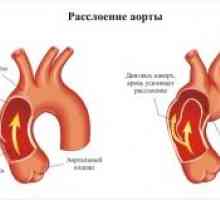 Аортна дисекация: симптоми, причини, лечение, симптоми, диагностика