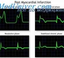 Възстановяване от инфаркт на миокарда. Почивка след сърдечен удар