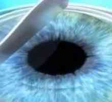 Рефрактивна хирургия на очите: Какво е това?