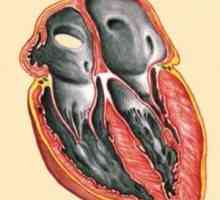 Рестриктивна кардиомиопатия