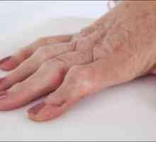 Ревматоиден артрит на пръстите: симптоми, лечение, причините, симптоми