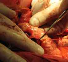 Резекция на главата и опашката на панкреаса дисталния и неговите последици